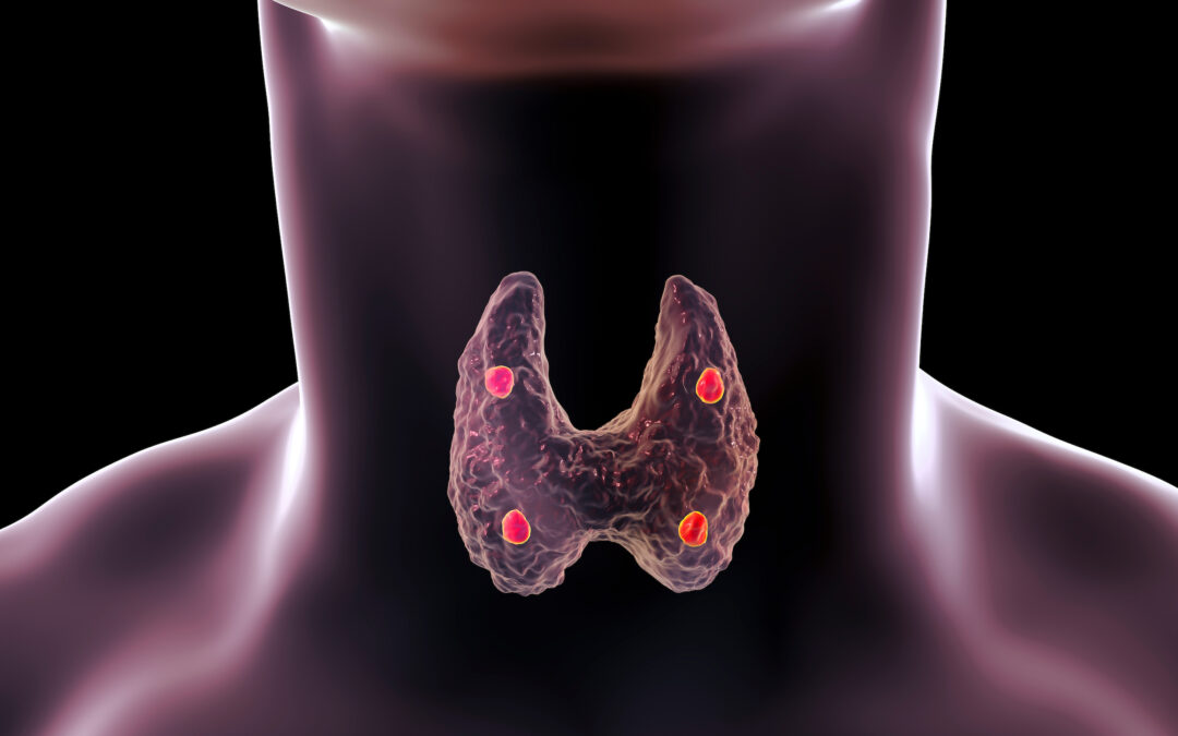 Πως ο ένας παθολογικός Παραθυρεοειδής (αδένωμα) επηρεάζει τους υπόλοιπους;